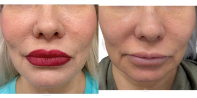 45-54 year old woman treated with Skin Tightening, Endolift - Full face slimming and lower face contouring.