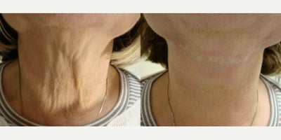Woman treated with Neck Lift, Nonsurgical Neck Lift - Woman treated with Neck Lift, Nonsurgical Neck Lift