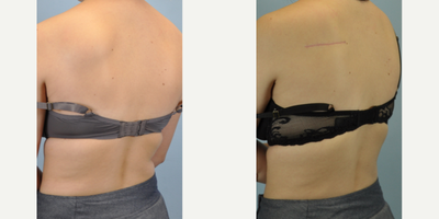 17 or under year old woman treated with Lipoma Removal - This lovely 16 year old presented with a lipoma of her left shoulder. This was excised and the scar was treated with BBL wavelengths to help it fade.