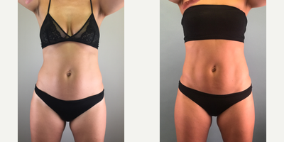 35-44 year old woman treated with Emsculpt - This patient was looking for a non-invasive treatment to slim and tone her post baby body.
