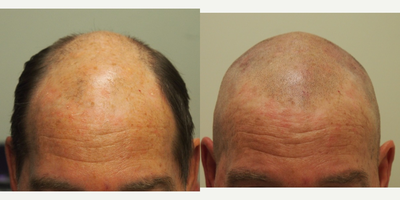 55-64 year old man treated with Scalp Micropigmentation wanted a very subtle shaved look - 55-64 year old man treated with Scalp Micropigmentation wanted a very subtle shaved look