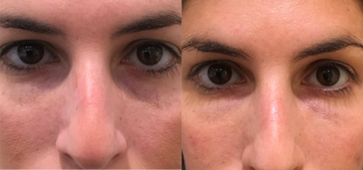 18-24 year old woman treated with Teosyal - This patient was treated for her under eye bags with Redensity II. 1 syringe was dispersed between the two eyes to achieve optimal results.