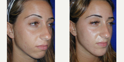 18-24 year old woman treated with Cheek Implants - 23 year old female underwent Chin Implant surgery under local anesthesia.