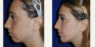 18-24 year old woman treated with Cheek Implants - 23 year old female underwent Chin Implant surgery under local anesthesia.