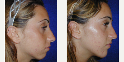 18-24 year old woman treated with Cheek Implants - 23 year old female underwent Chin Implant surgery under local anesthesia.