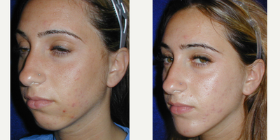 18-24 year old woman treated with Cheek Implants - 23 year old female underwent Chin Implant surgery under local anesthesia.