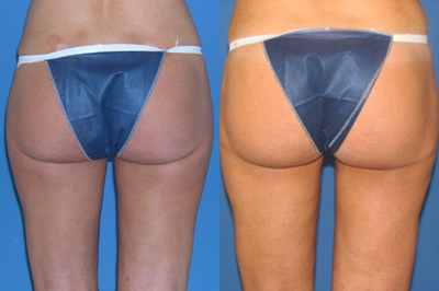 Butt Lift - 37 yo female who underwent a Del Mar butt tuck