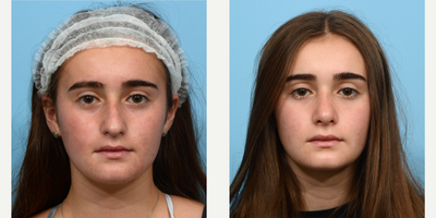 17 or under year old woman treated with Septoplasty - This 16-year-old patient was unhappy with her dorsal hump and was experiencing breathing issues. Dr. Wise performed a rhinoplasty and septoplasty, to smooth out her nose and balance her facial features, as well as to improve her breathing. Five months post-op, she is happy with how she looks and feels!