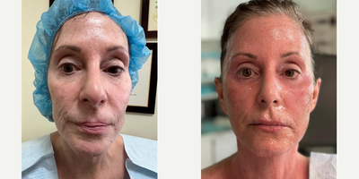 Woman treated with Mixto Laser, Radiesse, Fractional Laser, Laser Resurfacing, Sculptra - Mixto Fractional CO2 resurfacing, Radiesse & Sculptra were used to lift up the cheeks & tighten the skin. Healing time is about 5 to 7 days, results usually last for several years!
