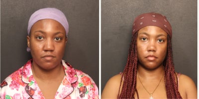 25-34 year old woman treated with African American Rhinoplasty, Weir Excisions - This case highlights nasal base narrowing with weir excisions combined with tip refinement, producing a slimmer nasal profile and improved nasal symmetry.