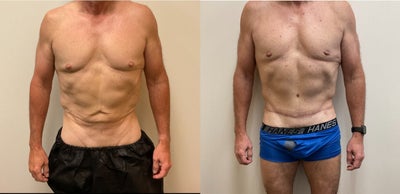45-54 year old man treated with Body Lift - 45-54 year old man treated with Body Lift
