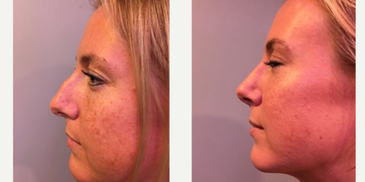 25-34 year old woman treated with Rhinoplasty - Female patient shown before and after rhinoplasty with cartilage graft from ear to nose,septoplasty, and dorsal hump reduction.