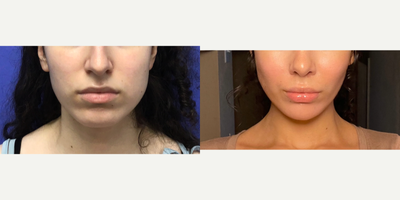 Patient treated with Chin Implant - Chin Implant (central) with Reduction and Contour - 18 to 24 year-old female patient is 1 month post-op from Facial Feminization surgery. Her procedures included: Forehead Lift, Hairline Lowering, Orbital Bony Contouring, Septorhinoplasty (closed) with Cartilage Grafts, Cheek Implants (small), Chin Implant (central) with Reduction and Contour, Soft Tissue to Nasolabial Folds, Intranasal Lip Lift with Fascia to Lips and 300 Micrografts to Recessions.