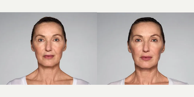 Woman treated with Restylane Refyne - 1.5 mL Restylane Refyne in nasolabial folds1.0 mL Restylane Refyne in marionette linesPhotos taken before treatment and 2 weeks after treatment