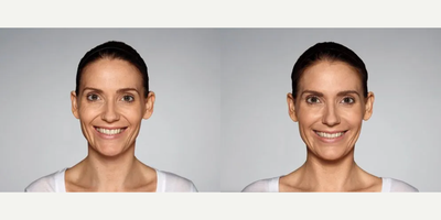 Woman treated with Restylane Defyne - 1.0 mL Restylane Defyne in nasolabial folds1.0 mL Restylane Defyne in marionette linesPhotos taken before treatment and 2 weeks after treatment