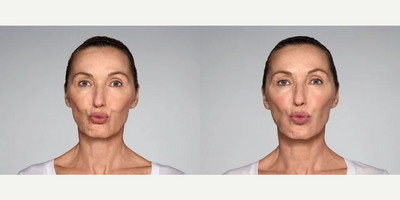 Woman treated with Restylane Refyne - 1.5 mL Restylane Refyne in nasolabial folds1.0 mL Restylane Refyne in marionette linesPhotos taken before treatment and 2 weeks after treatment
