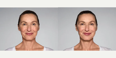 Woman treated with Restylane Refyne - 1.5 mL Restylane Refyne in nasolabial folds1.0 mL Restylane Refyne in marionette linesPhotos taken before treatment and 2 weeks after treatment