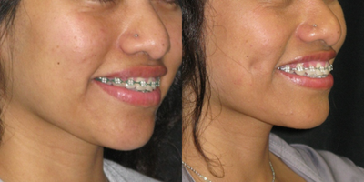 25-34 year old woman treated with Dimple Surgery - Patient with thinner cheeks get better results than patients with thicker cheeks. Initially the dimples are visible even at rest but later they fade away at rest and only appear when smiling. The last set of pictures demonstrates this.
