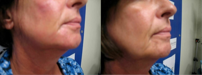 Woman treated with Renuva - Woman treated with Renuva.