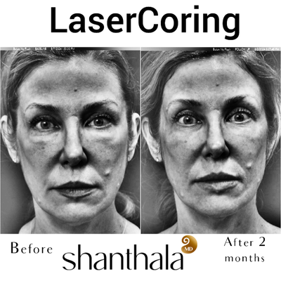 45-54 year old woman treated with Laser Resurfacing, Hyaluronidase, Skin Tightening, Skin Rejuvenation, Fractional Laser - Take a close look at this incredible transformation. Do you believe this patient underwent a facelift? You might be surprised to learn the truth.This stunning result is from just one session of Ultraclear Laser Coring on the full face and neck. In less than six months, Ive performed more than 50 of these procedures, truly transforming patients by restoring their natural beauty without surgery.