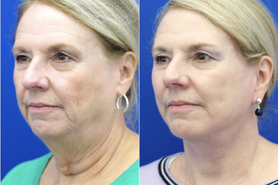65-74 year old woman treated with Deep Plane Facelift - 65-74 year old woman treated with Deep Plane Facelift