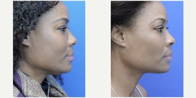 45-54 year old woman treated with Chin Liposuction, Buccal Fat Removal - This lady desires a minimalist approach to facial rejuvenation. Her concerns are the chubby cheek and chin fat exesss which make cheek fat reduction and chin liposuction the procedures of choice.