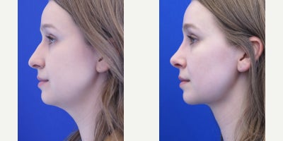 18-24 year old woman treated with Chin Liposuction, Rhinoplasty - At only three weeks post-op, she is already looking beautiful, albeit subtle and natural, after endonasal rhinoplasty, neck liposuction, and buccal fat removal, which constitute facial profile plasty.