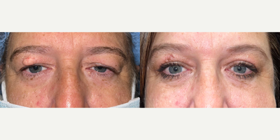 45-54 year old woman treated with Eyelid Surgery, Mole Removal, Ptosis Surgery - Upper eyelid blepharoplasty and ptosis repair + right brow lesion excision