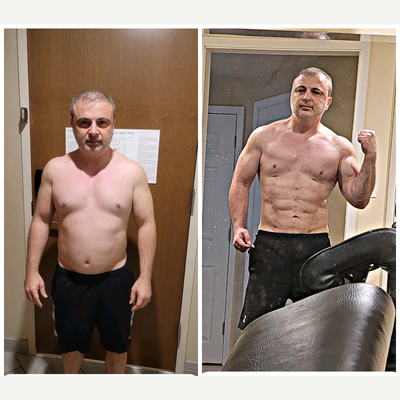 45-54 year old man treated with Abdominal Etching - 46 year old male who exercised regularly and good not get abdominal definition. Patient had HiDef abdominal and arm etching.