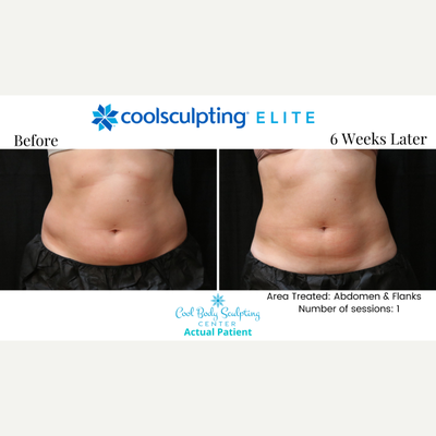 35-44 year old woman treated with CoolSculpting Elite - CoolSculpting Elite on the abdomen and flanks!