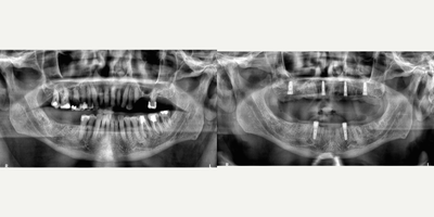 65-74 year old man treated with Dental Implants - Full mouth extractions with planned implant retained maxillary and mandibular dentures. Patient required bilateral maxillary sinus lifts.