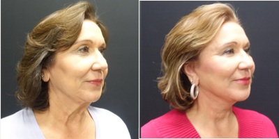 65-74 year old woman treated with Neck Lift - The patient underwent a high lateral SMAS face and necklift. The SMAS elevation supports the facelift so that their is minimal tension on the skin and enhance the possible longevity of the face and necklift. Along with the face and necklift she also had fat transfer to the face. Fat was transferred tough out the face and temples to restore the volume she has lost over time as we age. The combination of tightening and filling of the face gives her a much more youthful but natural appearance. This pictures show her two month result.