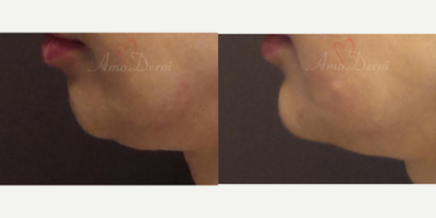 45-54 year old woman treated with Chin Filler, Juvederm, Voluma, Bellafill, Radiesse, Asclera - Non-surgical Chin augmentation and contouring with filler injection (Voluma, Bellafill, Radiesse)