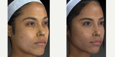 25-34 year old woman treated with Chin Surgery - This is a pretty young woman who came for chin, cheek and jawline sculpting for a softer and more elegant look. We did a combination of surgical approach to sculpt the jaw and chin, buccal fat removal and fillers. Looking good!DrC