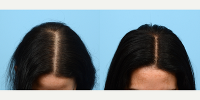 35-44 year old woman treated with PRP for Hair Loss, Hair Loss Treatment, HydraFacial - This patient underwent 3 sessions of PRP therapy for hair loss with Dr. Wise. Three months after her third session, she has susbtanial growth and more density to her hair.