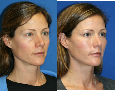 1 month post op: Full Face Fat Transfer - 
	1 month post op: Full Face Fat Transfer
