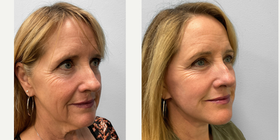 55-64 year old woman treated with Facelift, Laser Resurfacing - This woman in her late fifties had concerns about her fine lines and wrinkles. She met with Dr. Tucker to discuss her options for facial rejuvenation of which she chose to proceed with a facelift and TFX laser resurfacing. She looks great and is featured before and three months afterwards.