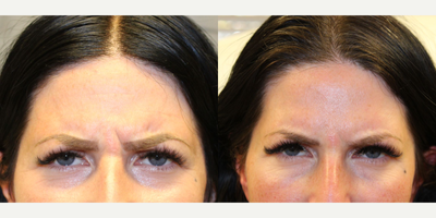 35-44 year old woman treated with Botox, RHA Collection Fillers - Botox and Lip Filler
