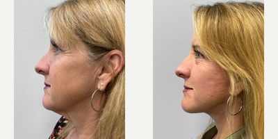 55-64 year old woman treated with Facelift, Laser Resurfacing - This woman in her late fifties had concerns about her fine lines and wrinkles. She met with Dr. Tucker to discuss her options for facial rejuvenation of which she chose to proceed with a facelift and TFX laser resurfacing. She looks great and is featured before and three months afterwards.