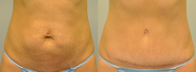 31 year old woman treated with Drainless Tummy Tuck - 31 year old female 9 months following a Drainless Tummy Tuck using a progressive tension technique.