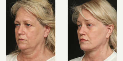 55-64 year old woman treated with Facelift, Brow Lift, Neck Lift, Facial Fat Transfer, Lip Surgery, Eyelid Surgery - This patient presented with facial changes due to aging. Her biggest concerns were brow ptosis with a significant amount of forehead wrinkling, as well as loose skin in the neck and jowls. The patient also presented with small lips and a lack of facial fat in the cheek area. A face/neck lift, anterior forehead lift, fat transfer to cheeks, and lip augmentation via fat graft were performed. These procedures significantly rejuvinated her face. Six months post op the patient returned for a consultation with the doctor regaurding her hooded eyelids. An upper eyelid blepharoplasty was performed.
