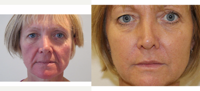 45-54 year old woman treated with Non Surgical Face Lift - Treatment: Sculptra collagen stimulating treatment combined with Silhouette Soft Thread Lifting (applied to jaw line, mid-face). Treatment performed by The Cosmetic Skin Clinic.