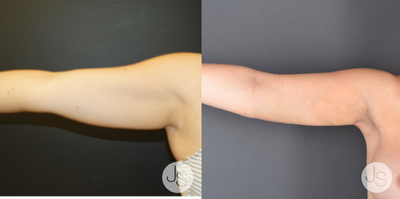 35-44 year old woman treated with BodyTite - BodyTite