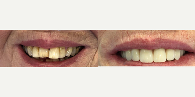75 and up year old woman treated with ClearChoice Dental Implants - Temporary All on Four hybrid denture