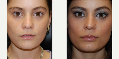 25-34 year old woman treated with Silikon 1000 for Lip Augmentation. 3 years post-injection - You can see natural looking and attractive lip augmentation in our gracious patient. We used Silikon-1000, an off-label filler for permanent results. She had her initial treatment three years ago.
