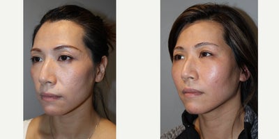 25-34 year old woman treated with ALMI - ALMI to cheeks, temples, brow31 yo, F, 54, 145lbs, G0P0VOL: 50ccASPX: 40ccFat Transfer Vol: 20mL/MFAT and 10mL/NF