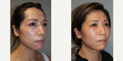25-34 year old woman treated with ALMI - ALMI to cheeks, temples, brow31 yo, F, 54, 145lbs, G0P0VOL: 50ccASPX: 40ccFat Transfer Vol: 20mL/MFAT and 10mL/NF