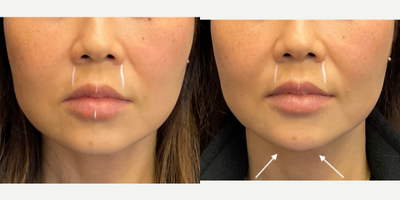 45-54 year old woman treated with Restylane Contour - 0.5 ml of Restylane Contour used to fill and shape the chin for a V line profile.