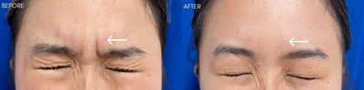 Woman treated with Botox - Woman treated with Botox