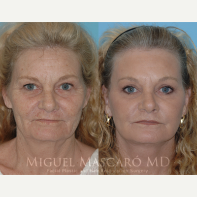 55-64 year old woman treated with Facelift - After extended deep plane face and neck lift with full face laser and upper blepharoplasty
